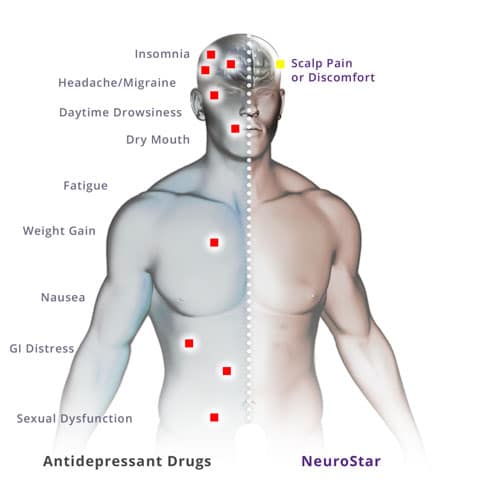 tms-side-effects TMS Side effects