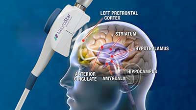 NeuroStar TMS Therapy Spokane Workings